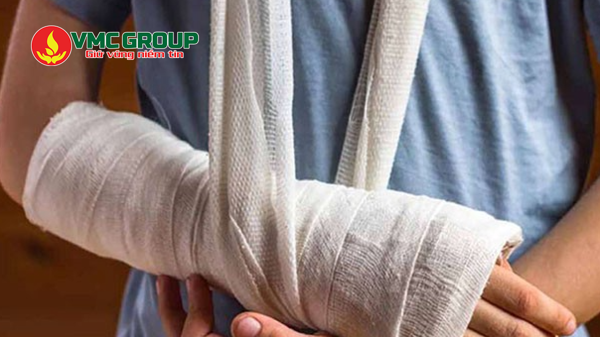 Thạch cao được ứng dụng trong bó bột y tế