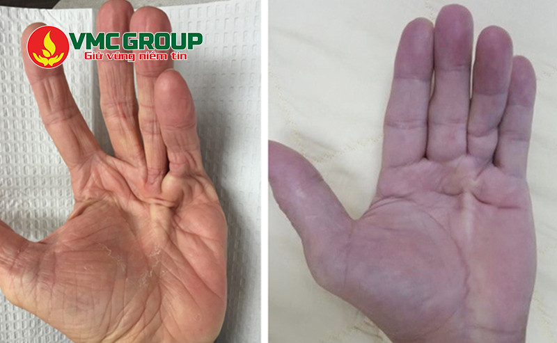Magnesium lactate có khả năng điều trị rối loạn thần kinh cơ